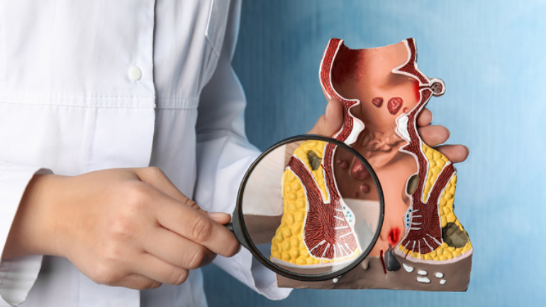 Kshara sutra en Ayurveda. El mejor procedimiento quirúrgico para el tratamiento de la fístula