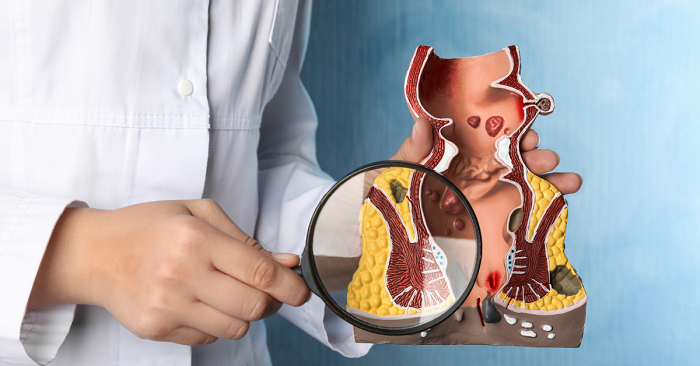 Kshara sutra en Ayurveda. El mejor procedimiento quirúrgico para el tratamiento de la fístula