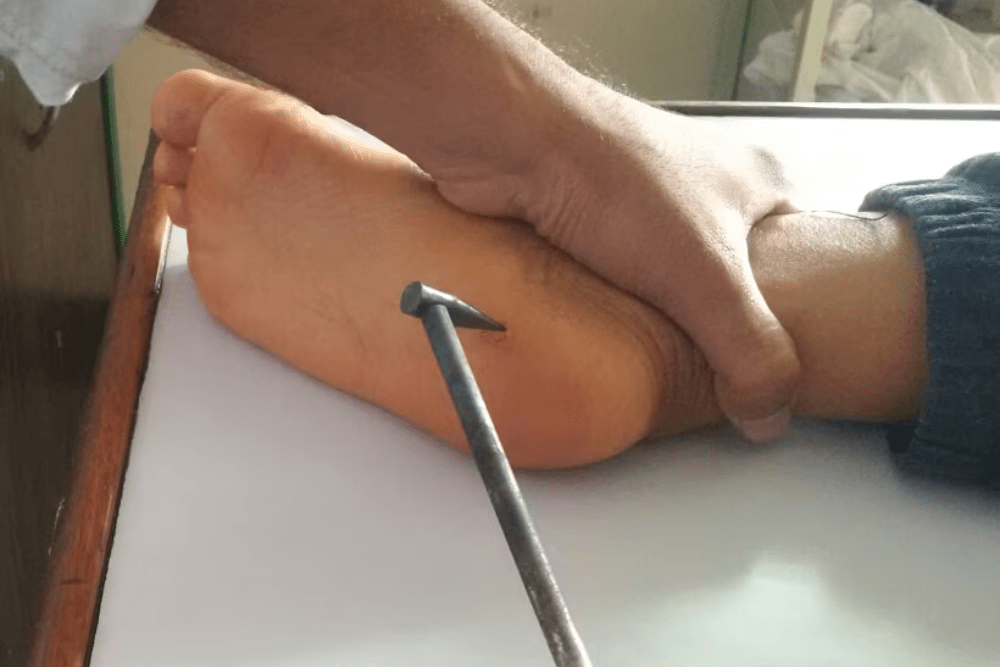 Agnikarma en Ayurveda