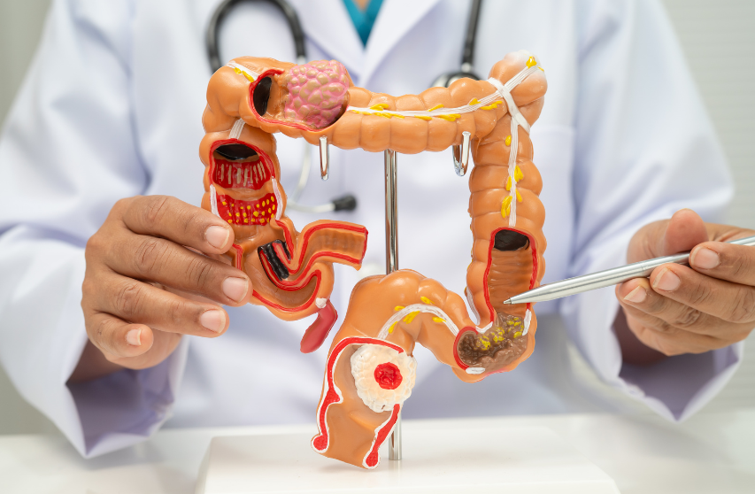 Dieta Ayurveda en el síndrome del intestino irritable
